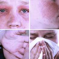 Средство Alergyx моментально устраняет все признаки аллергии